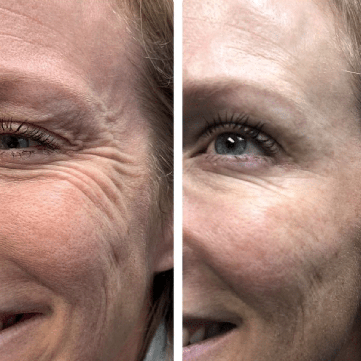 La Routine Complète Micro-Infusion & Collagène