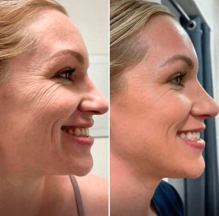 La Routine Complète Micro-Infusion Lift Pro®