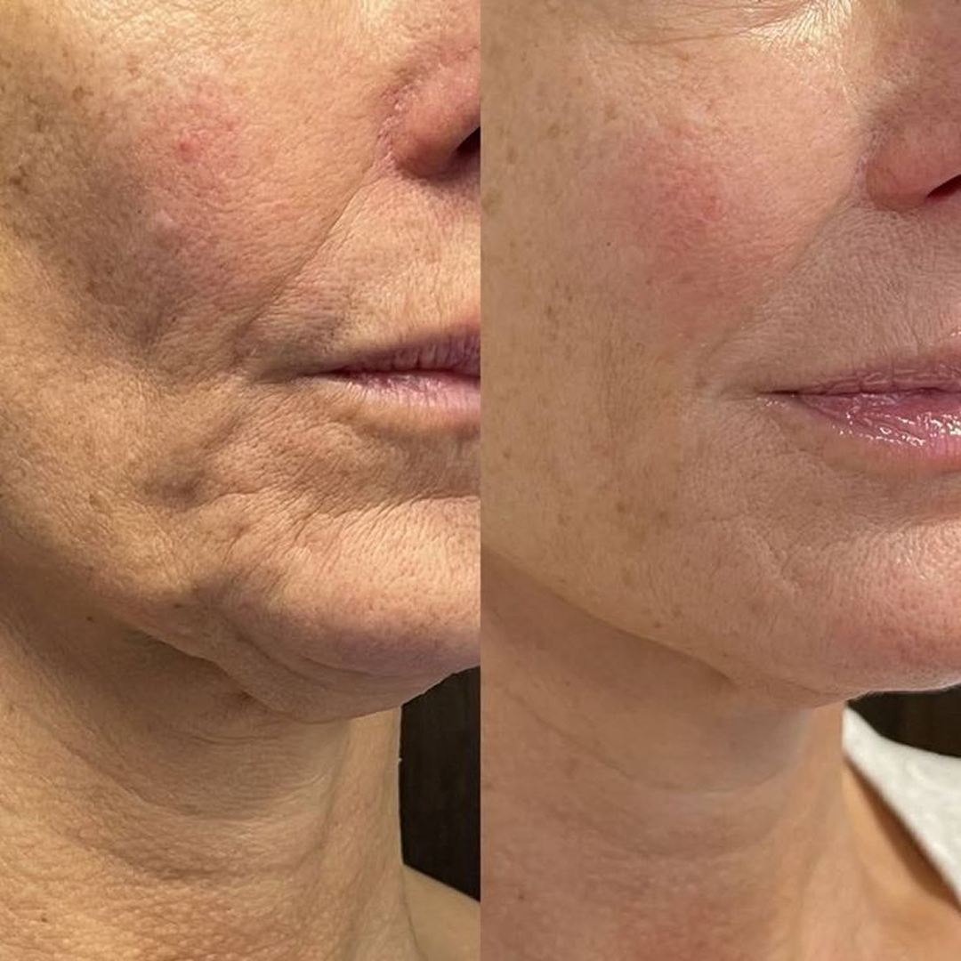 Micro-Infusion Lift Pro®