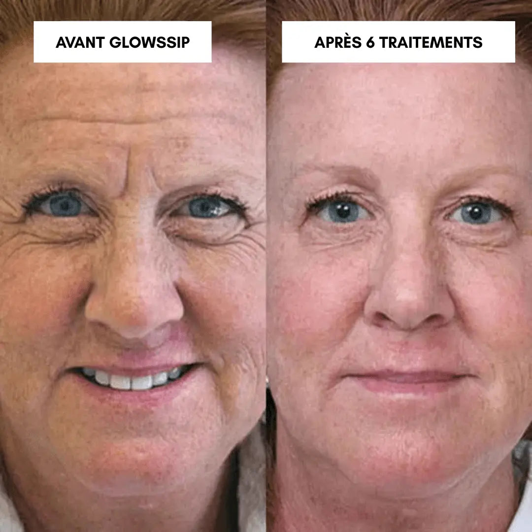 Micro-Infusion Lift Pro®