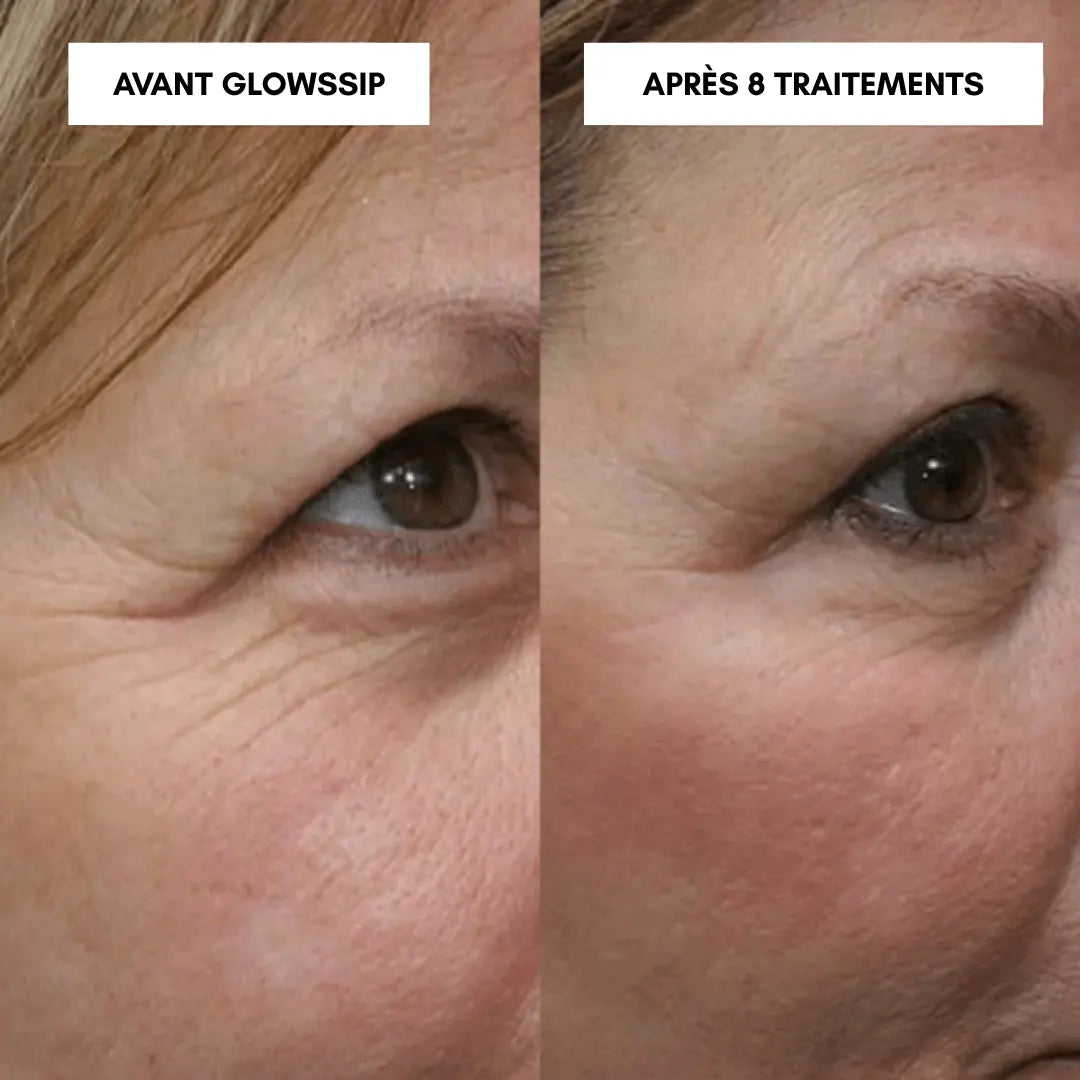 Micro-Infusion Lift Pro®