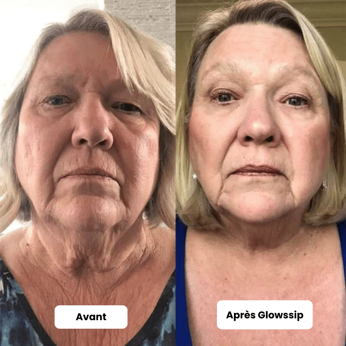 Pack Micro Infusion 3 MOIS