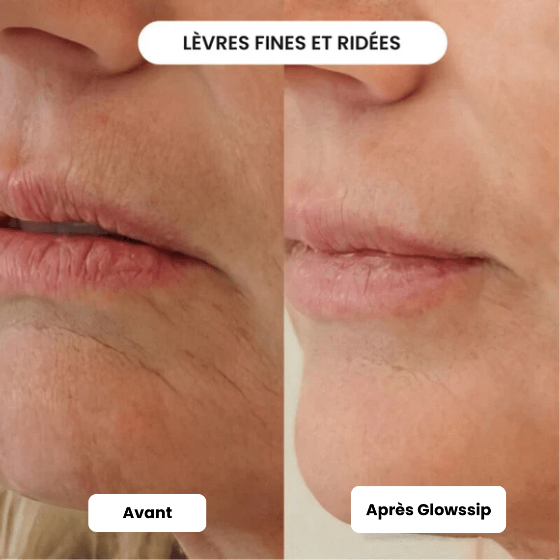 Traitement Micro-Infusion 1 Mois