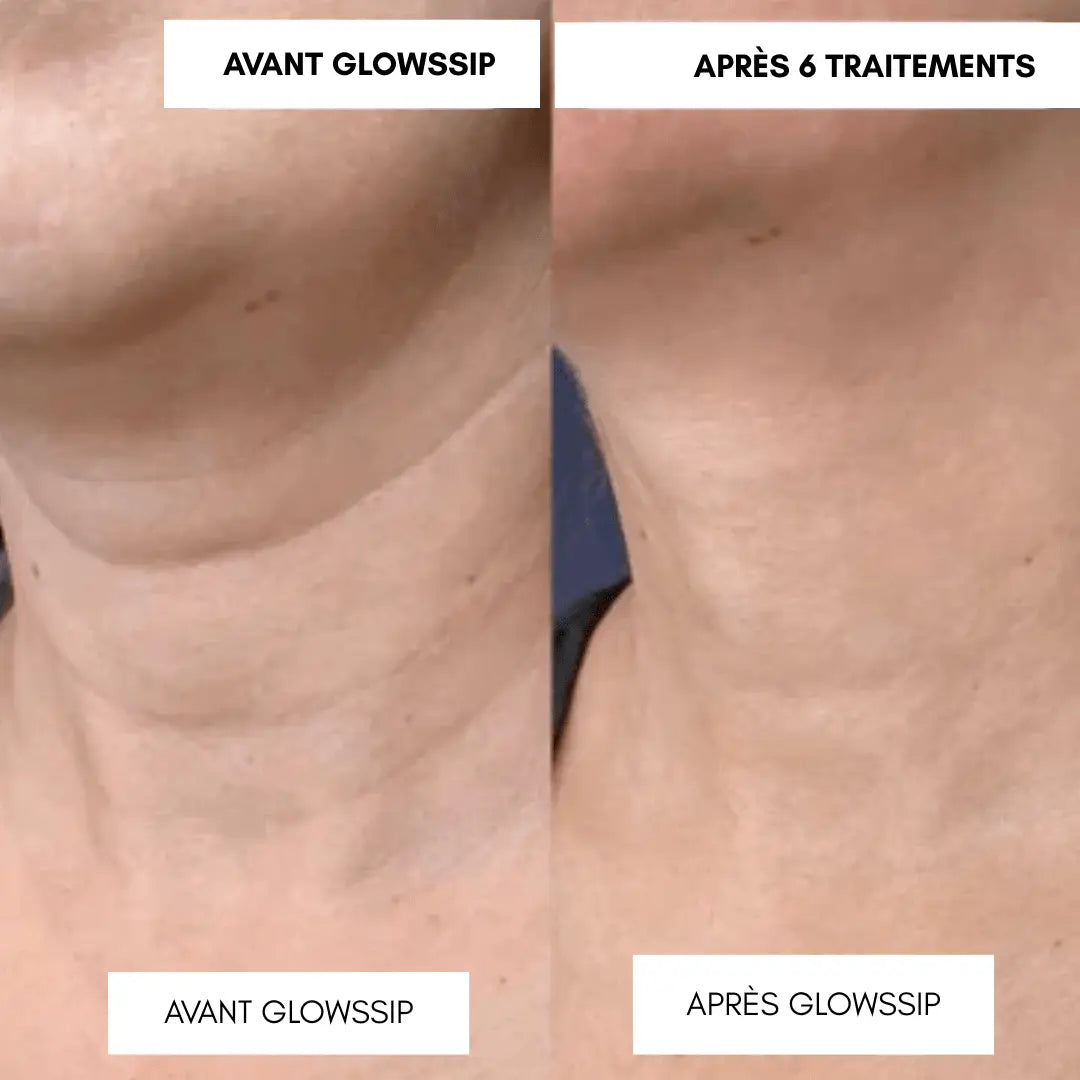 Micro-Infusion Lift PRO®