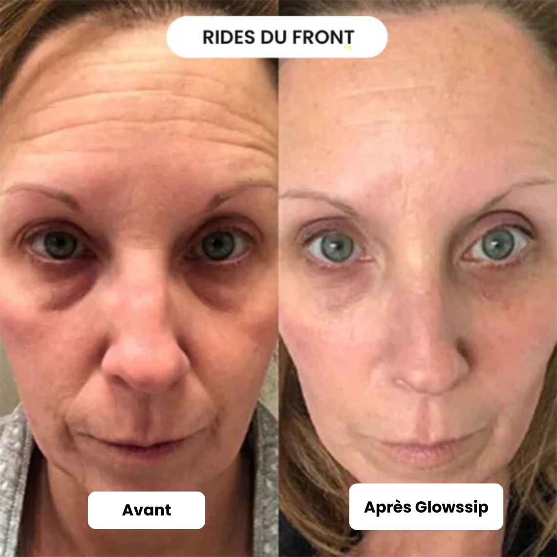 Pack Micro Infusion 3 MOIS