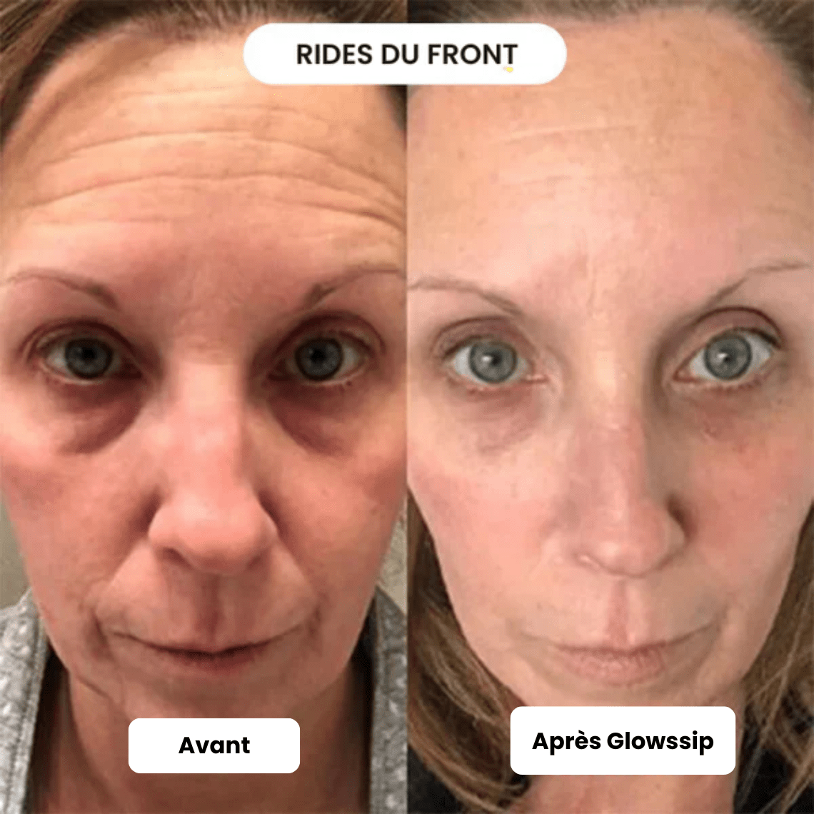 Pack Micro Infusion 3 MOIS