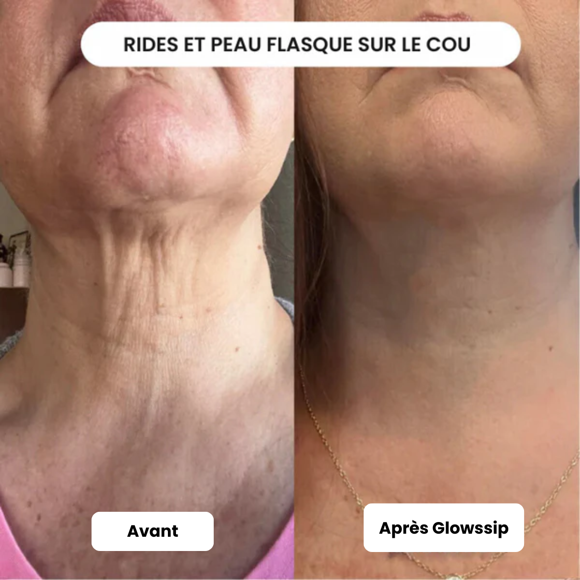 Pack Micro Infusion 3 MOIS
