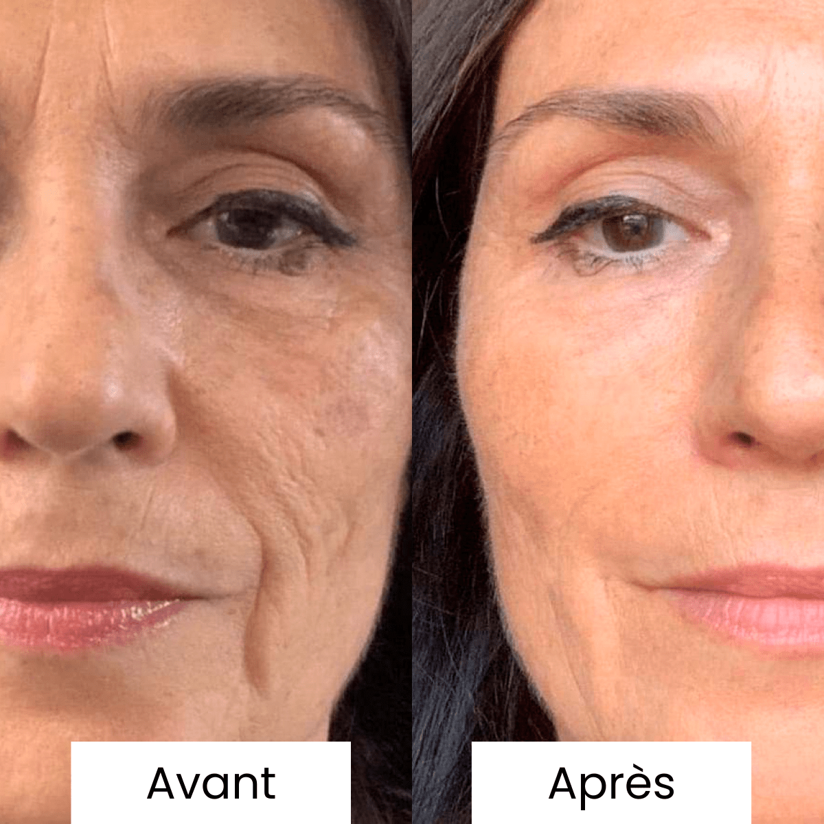 Micro Infusion: -65% +4 Cadeaux Offerts Aujourd&