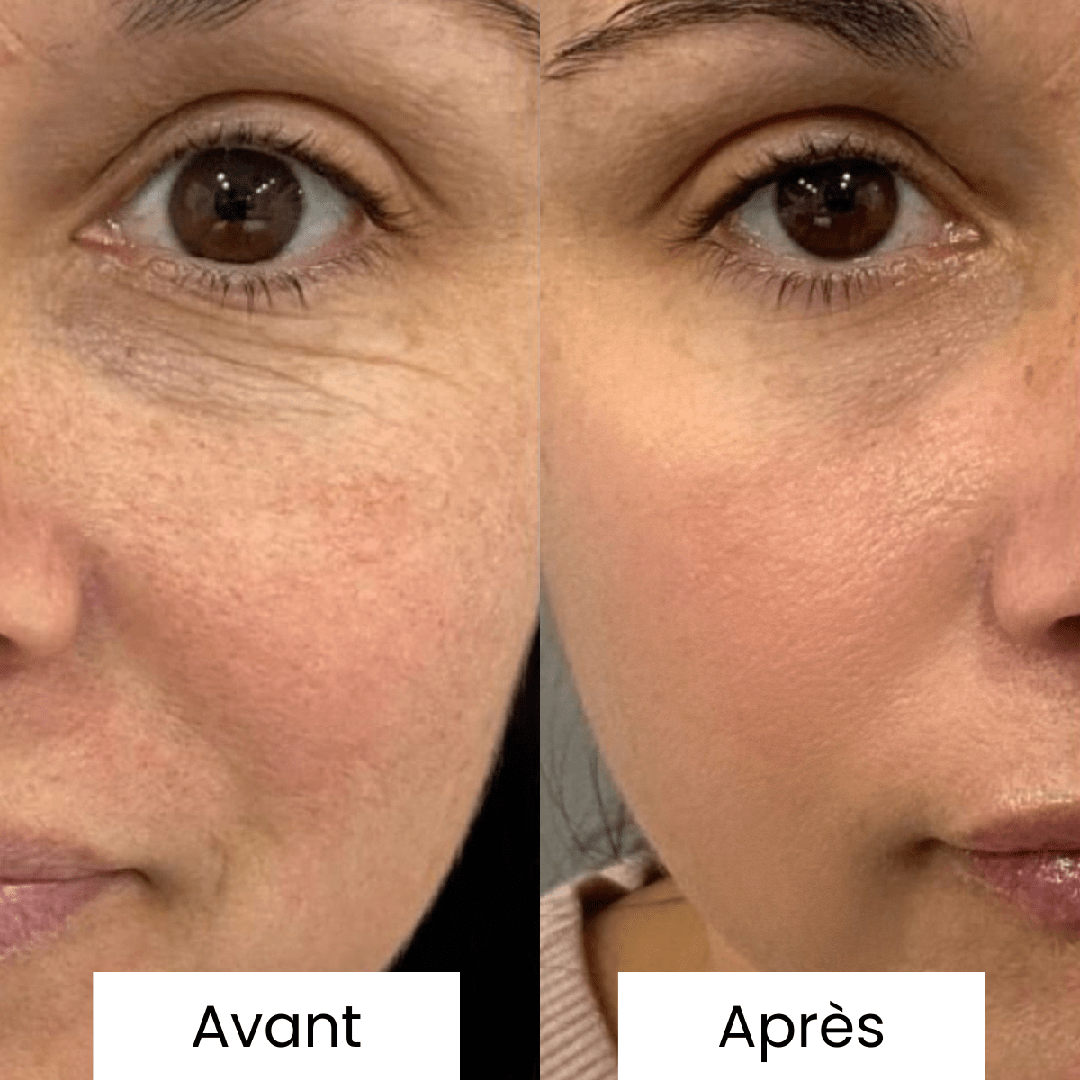 Micro Infusion Pro Anti-Taches