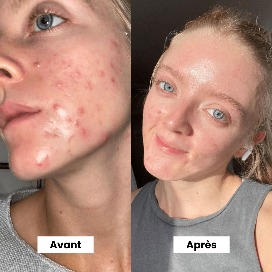 Micro Infusion: -65% +4 Cadeaux Offerts Aujourd&