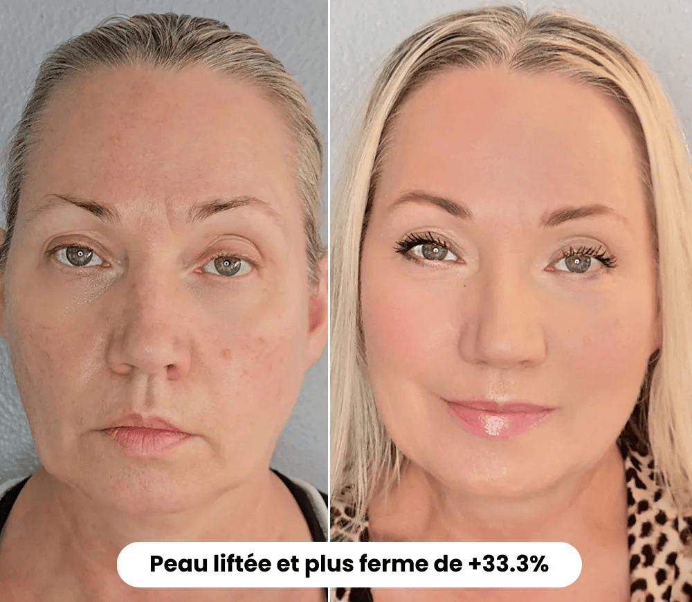 La Routine Complète Micro-Infusion Lift Pro®