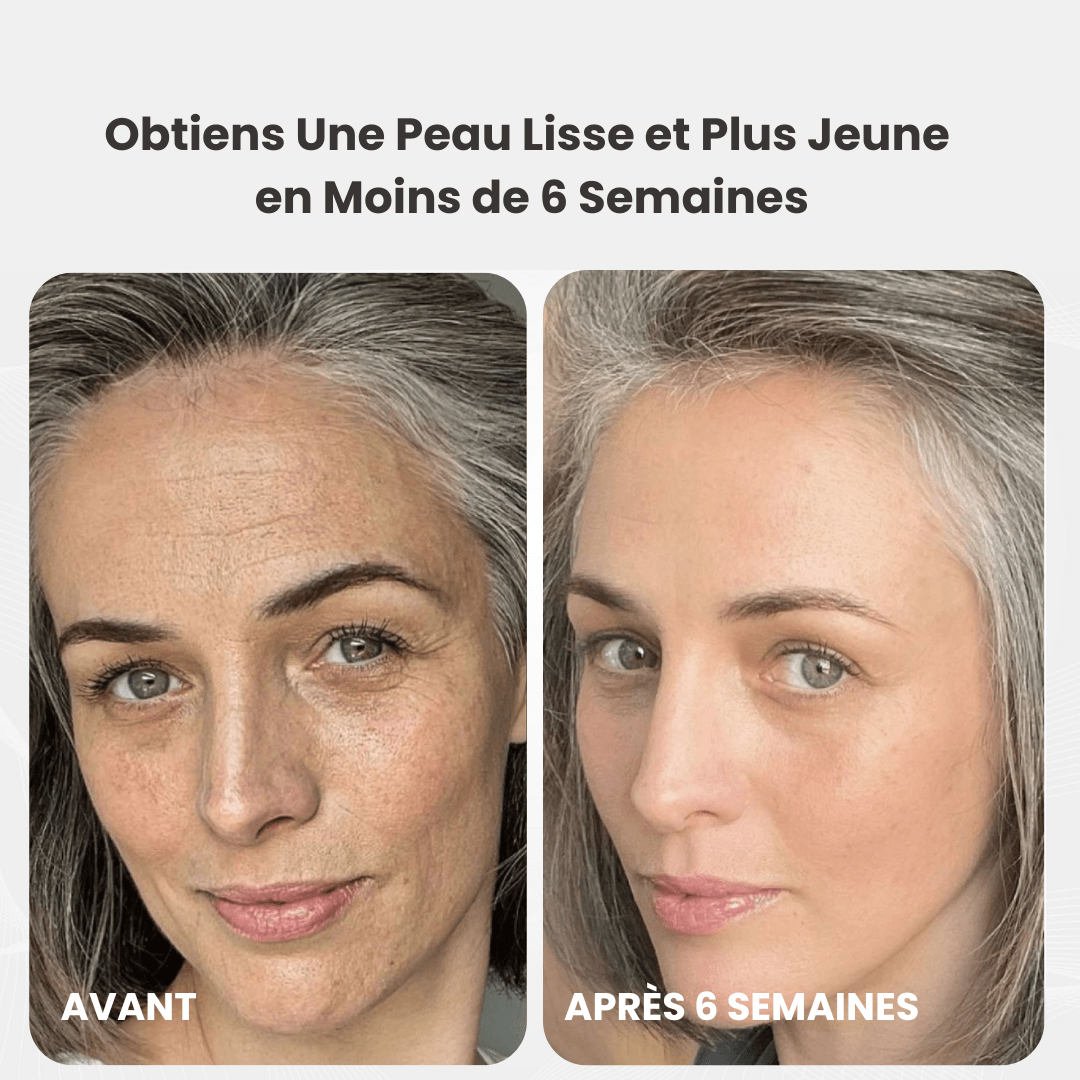 Micro Infusion 3 Mois + 2 Cadeaux Offerts