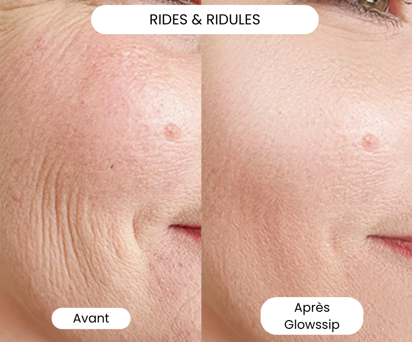 Micro-Infusion Lift Pro®