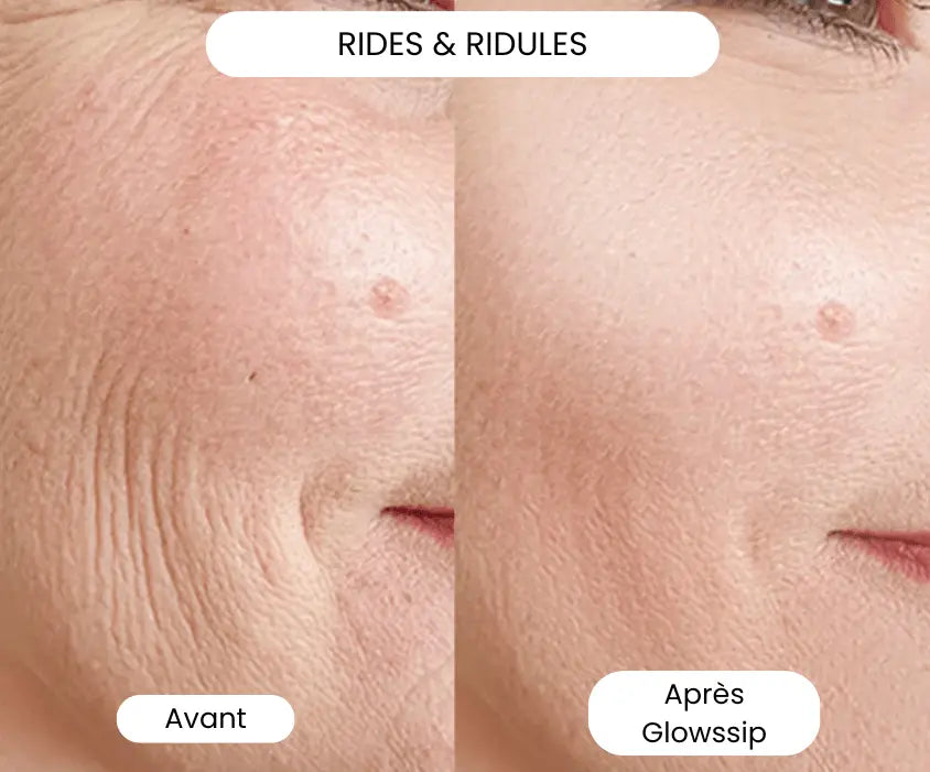 La Micro-Infusion Lift Pro®