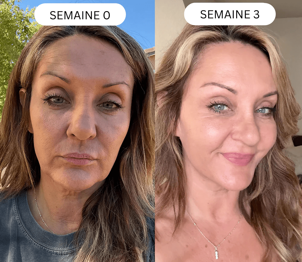 Micro Infusion 3 Mois + 2 Cadeaux Offerts