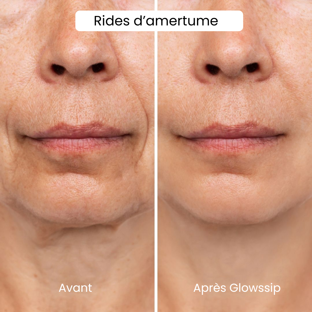 Micro-Infusion Lift Pro®