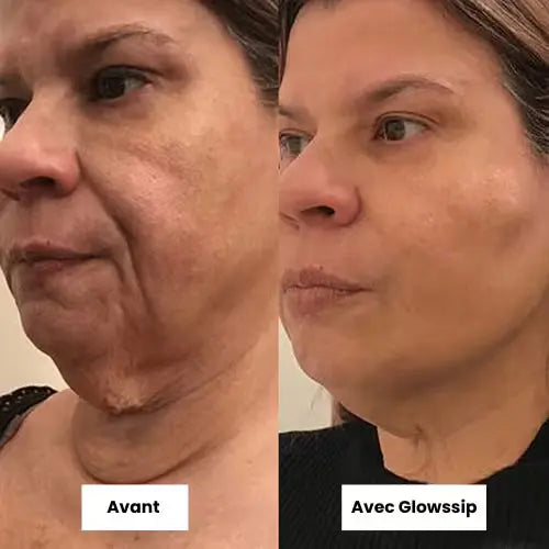 La Micro-Infusion Lift Pro®