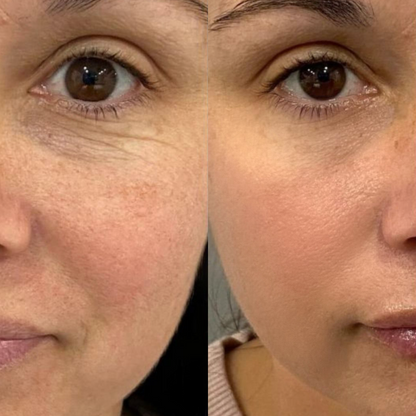 La Routine Complète: Micro-Infusion &amp; Collagène