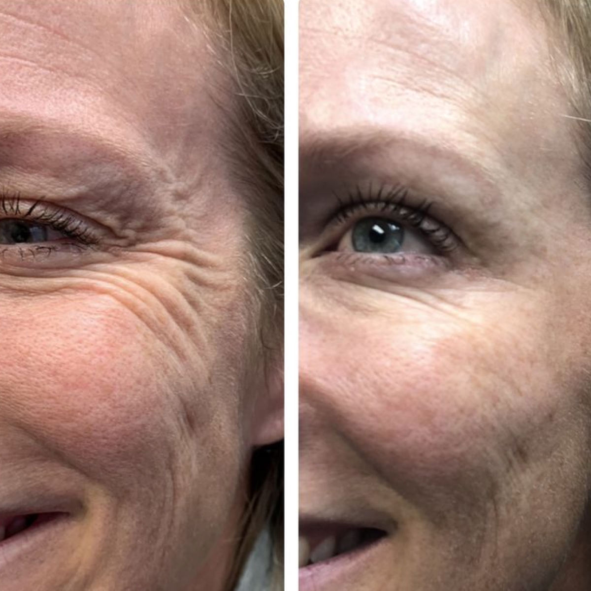 La Routine Complète: Micro-Infusion &amp; Collagène