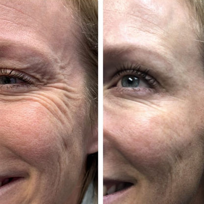 La Routine Complète: Micro-Infusion &amp; Collagène