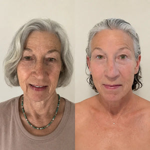 Micro-Infusion Lift Pro®