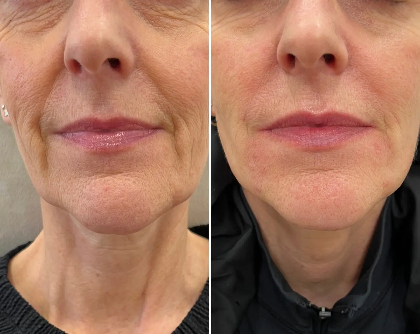Micro-Infusion Lift Pro™