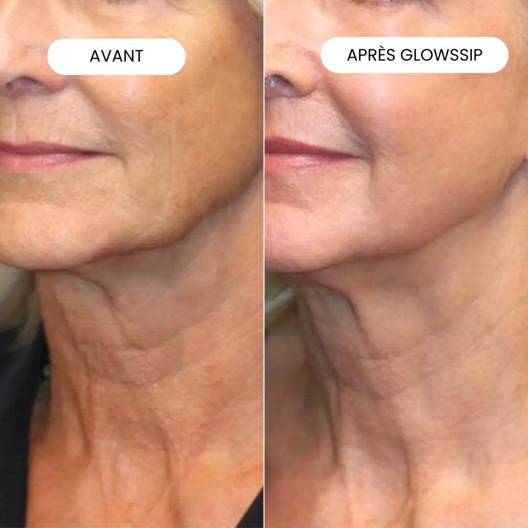 Micro-Infusion Lift Pro®