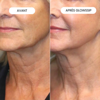 Micro-Infusion Lift Pro®