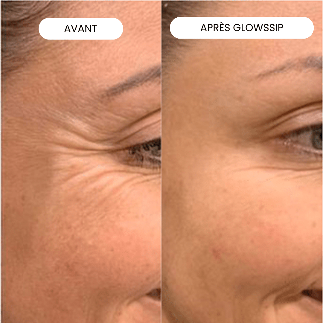Micro-Infusion Lift Pro®