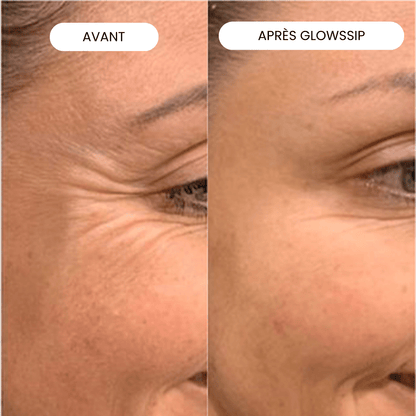 Micro-Infusion Lift Pro®