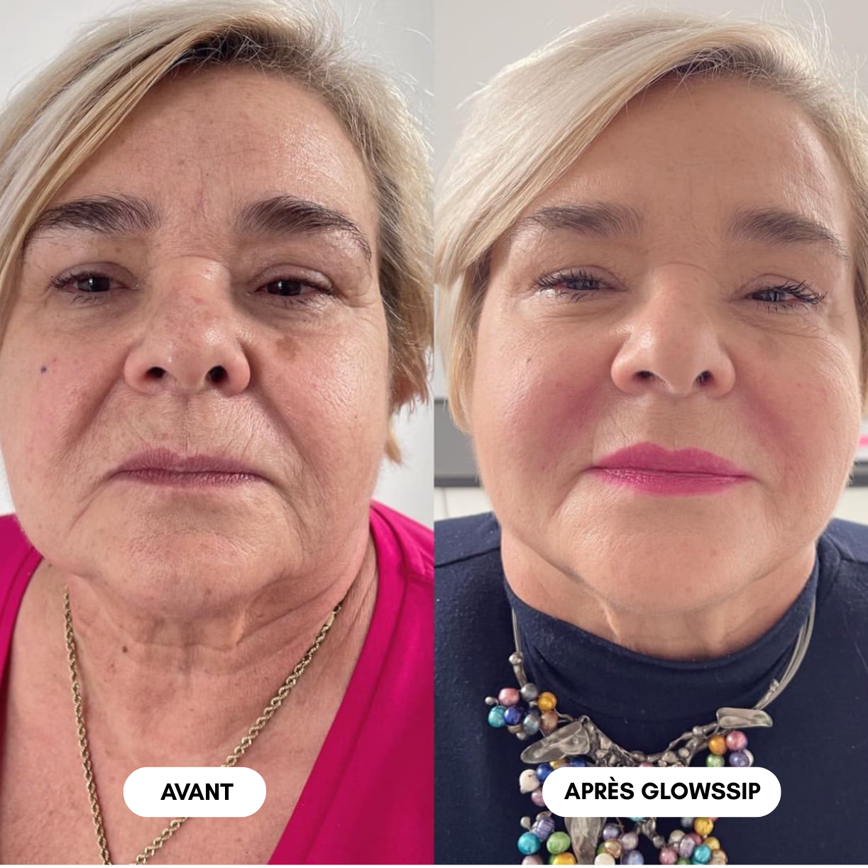 2 Mois Micro-Infusion + 1 Mois Offert 🎁