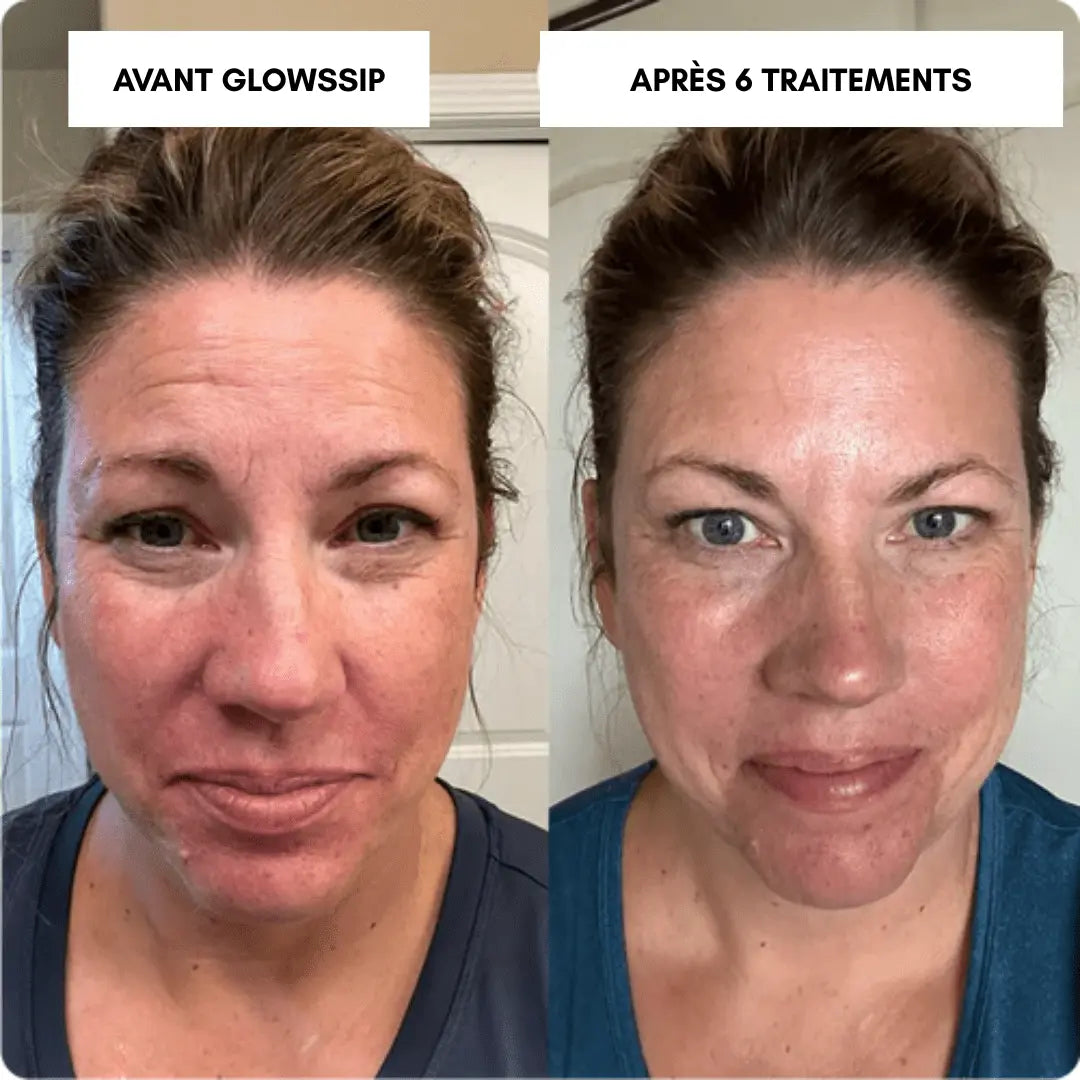 Micro-Infusion Lift PRO®