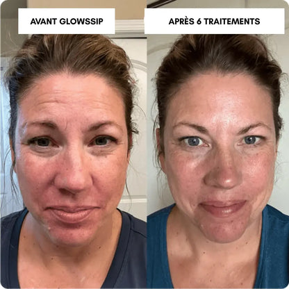 Micro-Infusion Lift PRO®