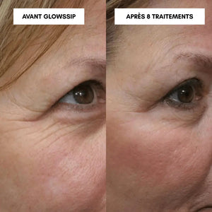 Micro-Infusion Lift Pro®