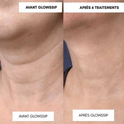 Micro-Infusion Lift PRO®