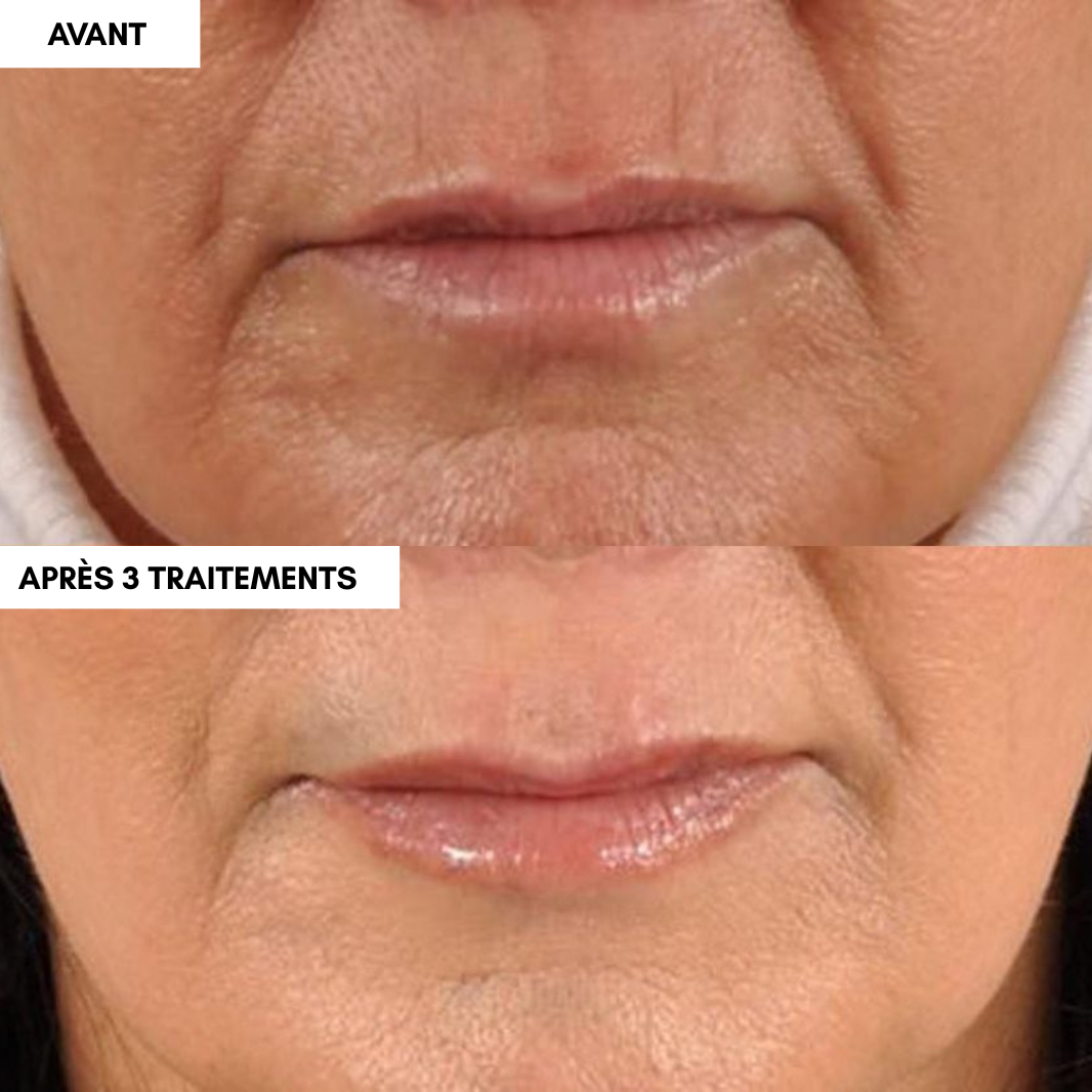 2 Mois Micro-Infusion + 1 Mois Offert 🎁