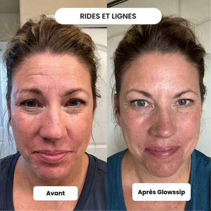 Micro-Infusion Lift Pro®
