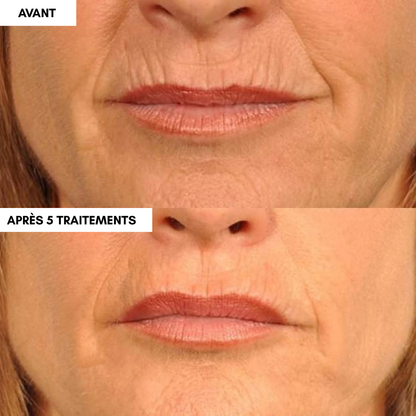 2 Mois Micro-Infusion + 1 Mois Offert 🎁