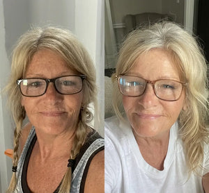 Micro-Infusion Lift Pro®