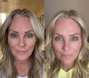 Micro-Infusion Lift Pro®