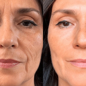 Micro-Infusion Lift Pro™