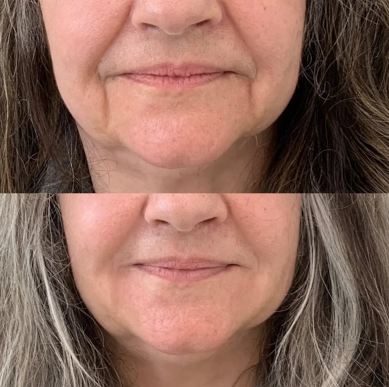 Micro-Infusion Lift Pro™