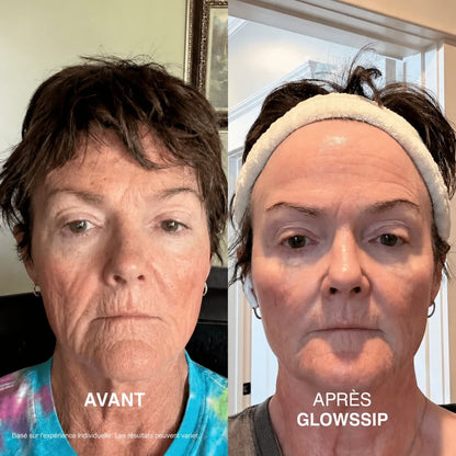 La Micro-Infusion Lift Pro®