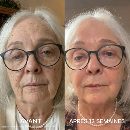 La Micro-Infusion Lift Pro®