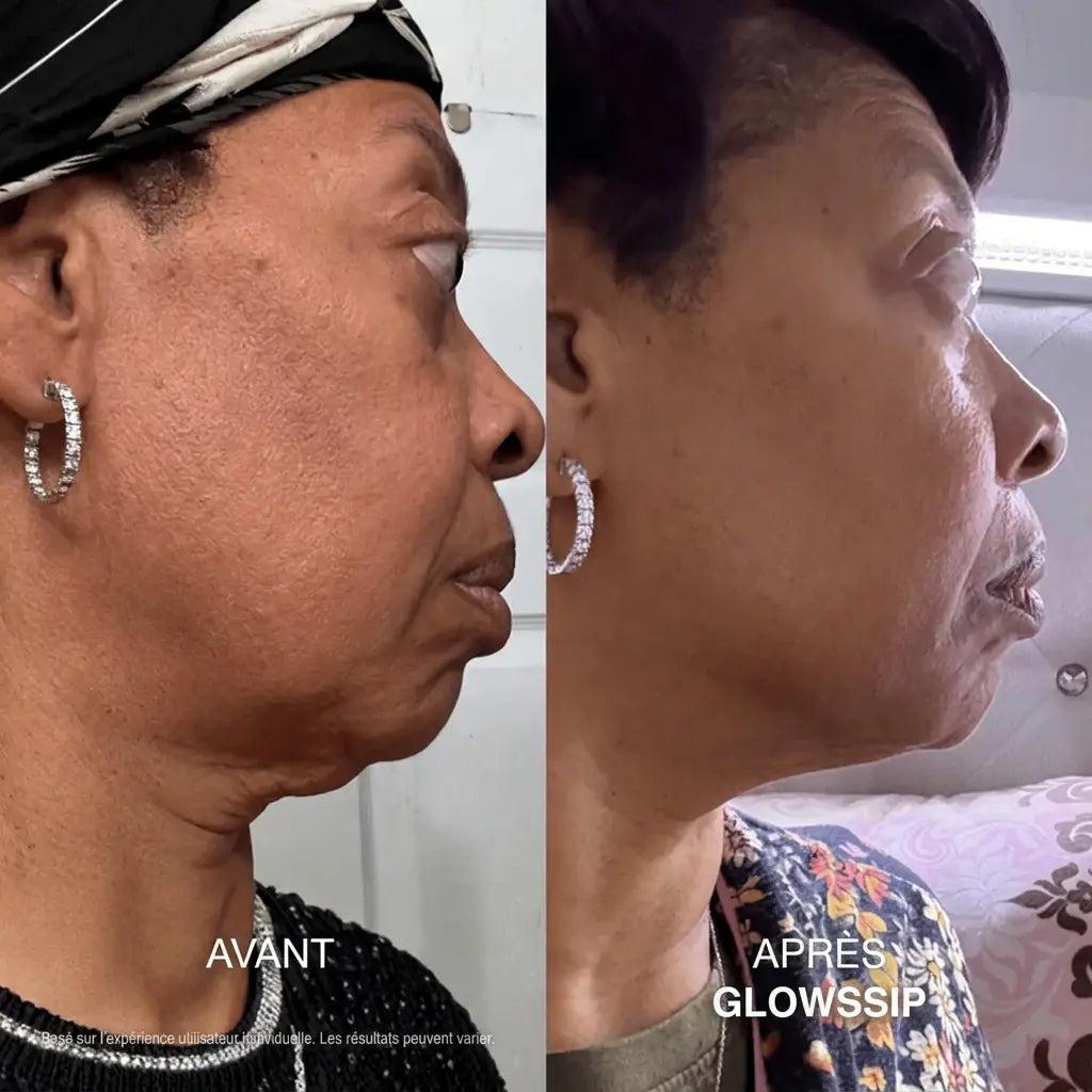 Micro-Infusion Lift PRO®