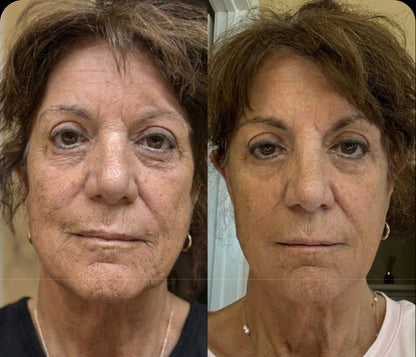 Micro-Infusion Pro®