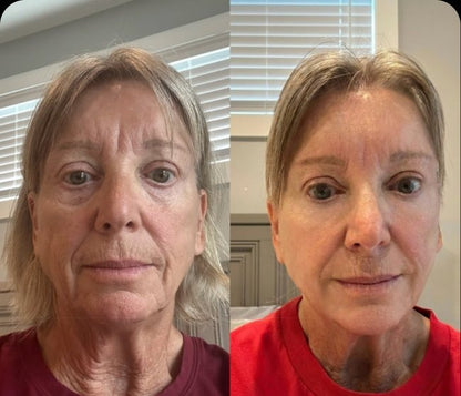 Micro-Infusion Lift Pro®