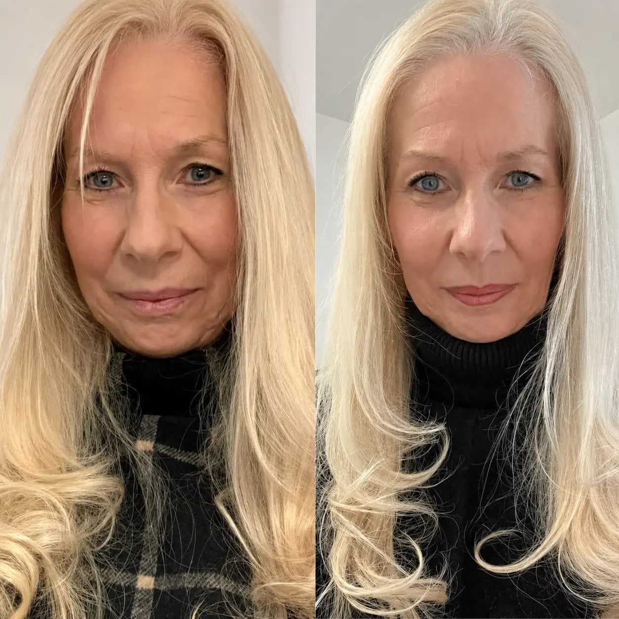 Micro-Infusion Lift Pro™