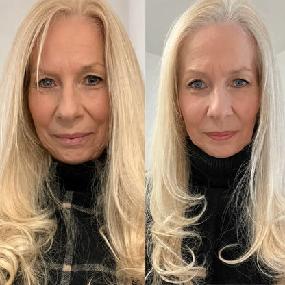 Micro-Infusion Lift Pro®